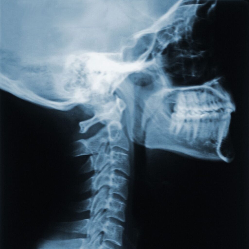 Una radiografía de un cuello
